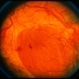 Proliferative Diabetic Retinopathy